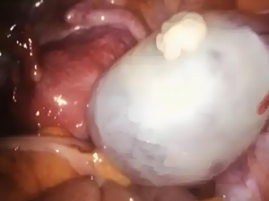 What does a vaginal cyst look like​ ﻿